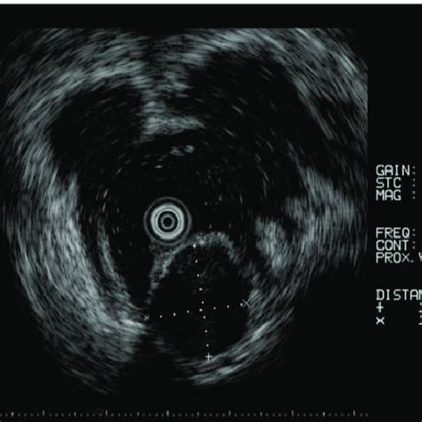 Endoscopic Us Showing A Hypoechoic Mass Of 17×16 Mm In The 4th Layer