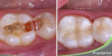 Obturaci N Dental Est Tica Qu Es La Obturaci N Dental Y Para Que Sirve