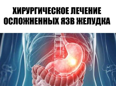 Хирургическое лечение осложненных язв желудка - презентация онлайн
