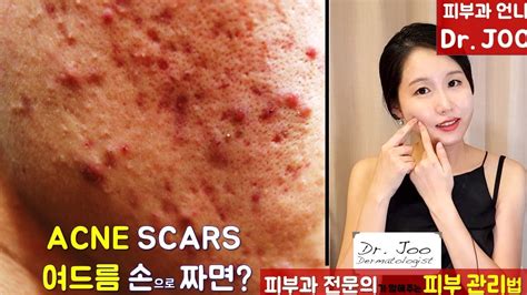 Eng Sub 피부과전문의가 알려주는 여드름 스킨케어ㅣ How To Prevent Acne Scar By A