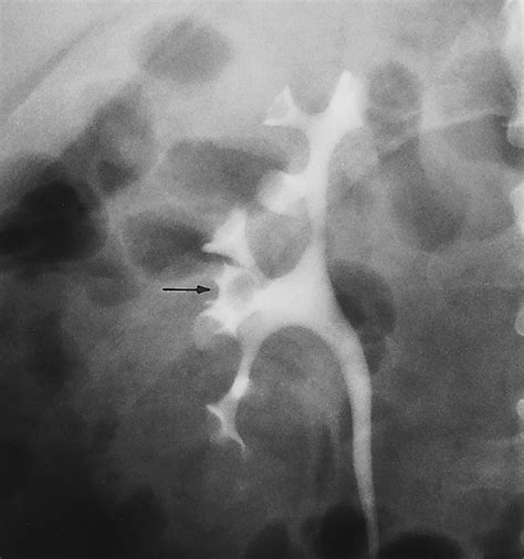 Intravenous Urography Technique And Interpretation Radiographics