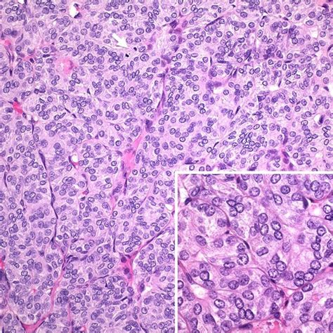 Rate of non-invasive follicular thyroid neoplasms with papillary-like nuclear features depends ...