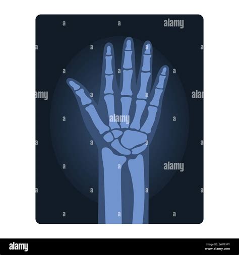 Xray Shot Of Human Hand Medical Injury Test Body Radiography Cartoon