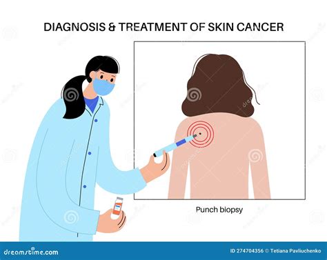 Punch Biopsy Procedure Cartoon Vector | CartoonDealer.com #274704105