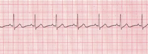 EKGs Flashcards Quizlet