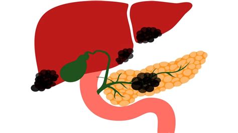 Nejčastější Příznaky Rakoviny Slinivky Světkreativity
