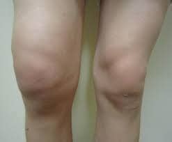 Swollen Knee Causes Diagnosis Treatment Knee Pain Explained