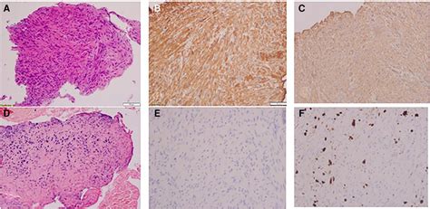 Figure 1 From Epstein Barr VirusAssociated Pulmonary Leiomyoma In A