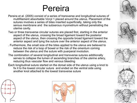 Uterine Compression Sutures Ppt