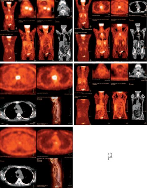 Figure From Imagerie Radiologique Et Tep Scanner Dans Les Cancers Orl