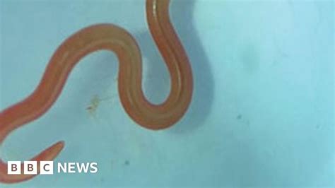 Live Worm Found In Australian Woman S Brain In World First