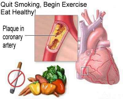 Ischemic Heart Disease (IHD) - symptoms and treatment | Health Dictionary