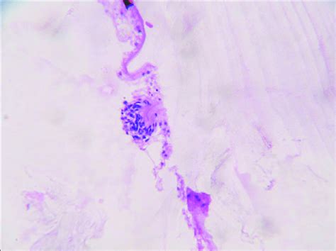 Photomicrograph Of Surgical Specimen Showing A Presence Of Laminated