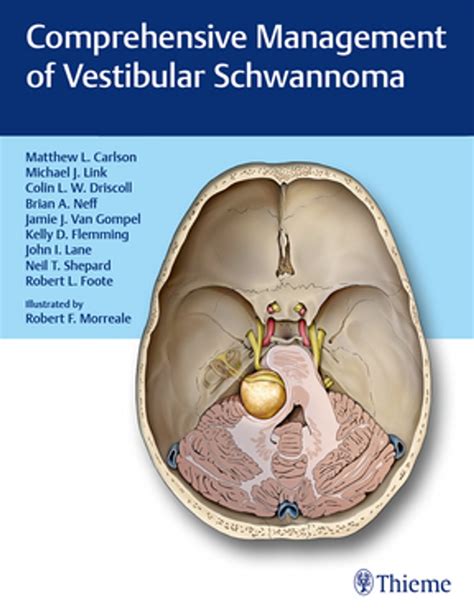 Comprehensive Management of Vestibular Schwannoma eBook by - EPUB Book ...