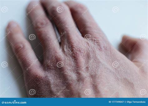 Man With Sick Hands Dry Flaky Skin On His Hand With Vulgar Psoriasis