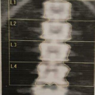 Lumbar Spine BMD Examination | Download Scientific Diagram