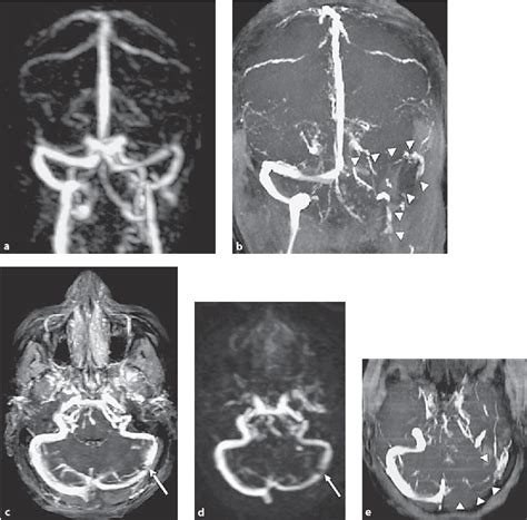 Display Of Dural Sinuses With Time Resolved Contrast Enhanced Three