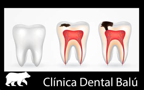 Prevenci N De Caries Dental Consejos Para Una Sonrisa Saludable Bal