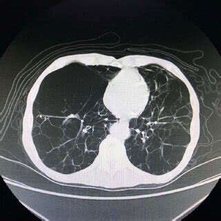 Preoperative Chest Computed Tomography Image Diffuse Low Attenuation