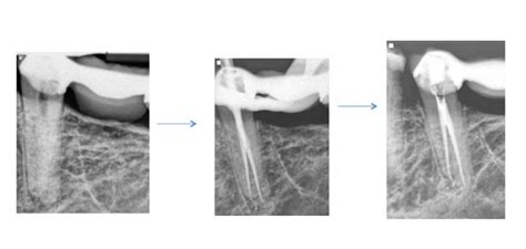 Root Canal Anatomy - Mandibular Bicuspid