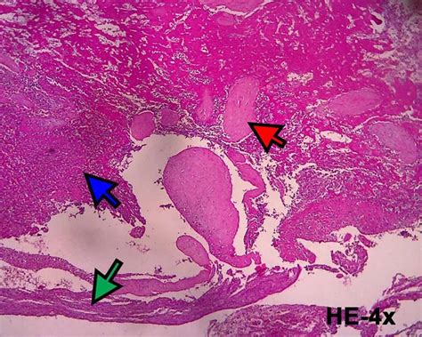 Histopathological Examination Confirmed The Diagnosis Of Cesarean Scar