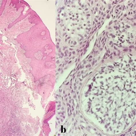 A Photomicrograph Showing Nests And Islands Of Proliferating