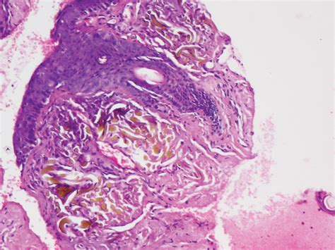 Ochronosis Histology