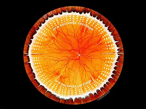 Preventing Retinal Detachment The Encircling Laser Retinopexy Techniq