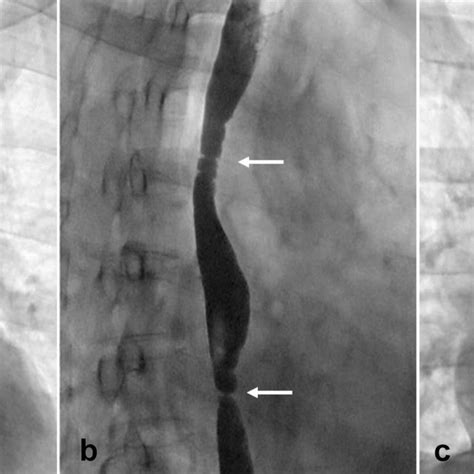 A 44 Year Old Man With Benign Esophageal Stricture For 4 Years Was