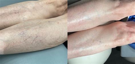 Sclerotherapy Laser Vein Treatment Before After Photos Patient