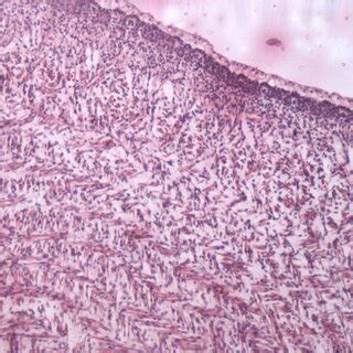 Photomicrograph Showing Well Defined Basement Membrane Arrows In