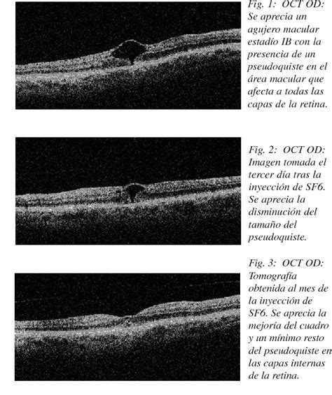 Figure 1 from Tratamiento del agujero macular idiopático en estadío