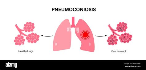 Pneumoconiosis Lung Disease Illustration Stock Photo Alamy