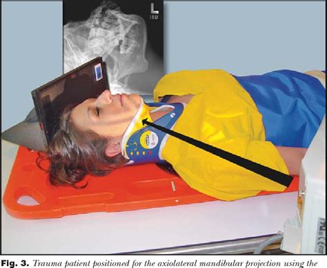 Pdf Trauma Radiography Of The Mandible Semantic Scholar