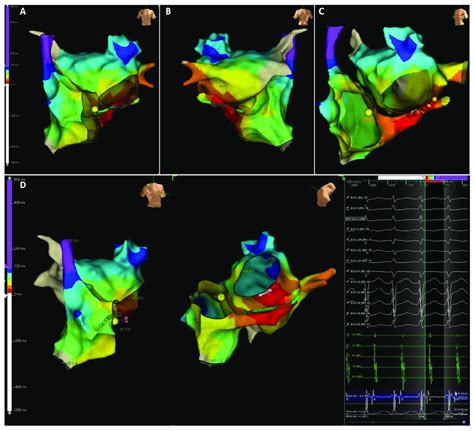 Supraventricular Tachycardia Due To Left Accessory Pathway Activation