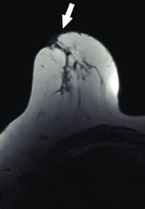 Axial T1 Weighted Mri Of A 66 Year Old Woman With Ductal Carcinoma In