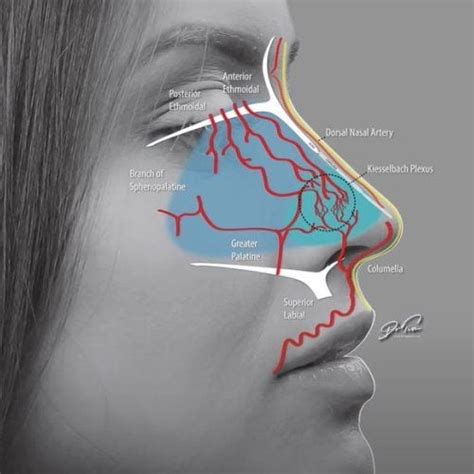 Septum Necrosis Non Surgical Rhinoplasty Complication Dr Tim Pearce