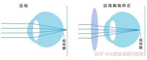 一篇看懂：近视、远视、散光和老花 知乎