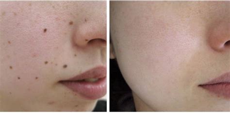 Laser Mole Removal | Summer Special Offers