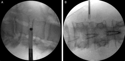 Lateral A And Anteroposterior B Fluoroscopic Images Ensure That The