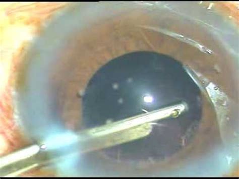 Phaco Of An Intumescent Cataract With Shallow AC And Mid Dilated Pupil