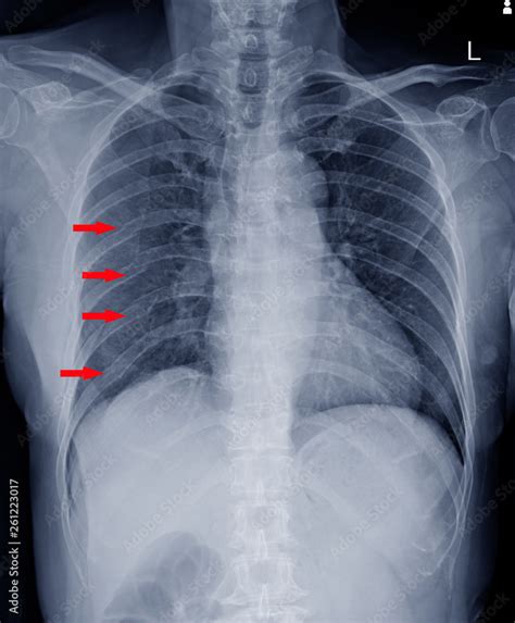 X Ray Chestfinding Multiple Fracture Ribs On Red Arrows Mark Stock