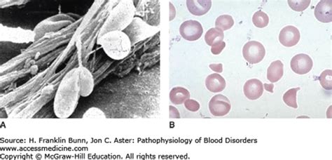 Acquired Coagulation Disorders Basicmedical Key