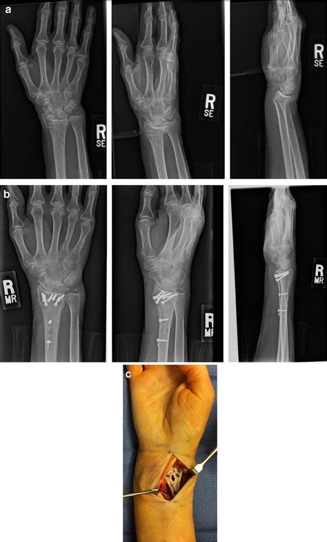 A Pre Operative Radiographs Of A Comminuted Dorsally Angulated Distal