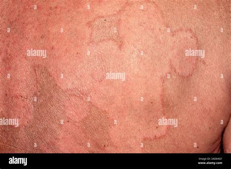 Ringworm Rash Close Up Of A Rash On The Back Of A 59 Year Old Male