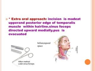 Infra temporal space infection ppt | PPT