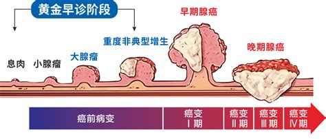 肠息肉到底要不要切？运城众泰医院切肠息肉专业吗 哔哩哔哩