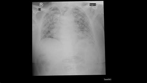 X Ray Imaging For COVID 19 Patients