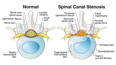 Lakeland Florida Minimally Invasive Lumbar Decompression MILD