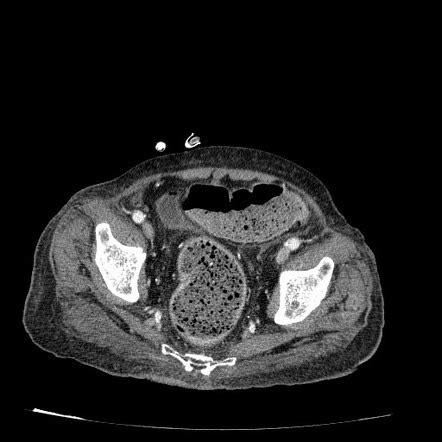 Stercoral Perforation Radiology Reference Article Radiopaedia Org